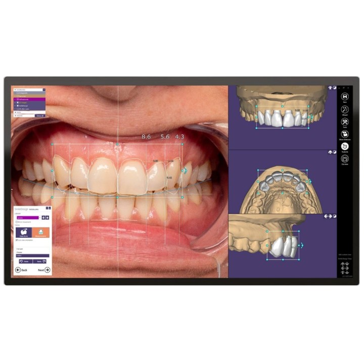 Exoplan Software by Exocad